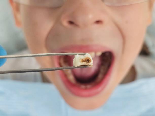 Best Knocked-Out Tooth Emergency  in Somerset, PA